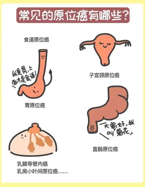 一张图看懂「原位癌」是个啥?