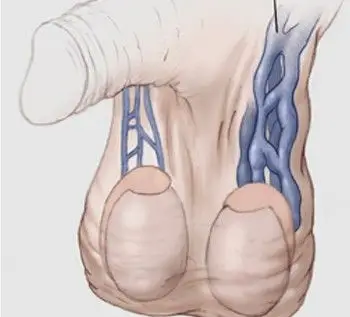 精索静脉曲张怎么治疗