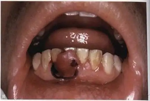 牙龈癌早期症状图片(21)_有来医生