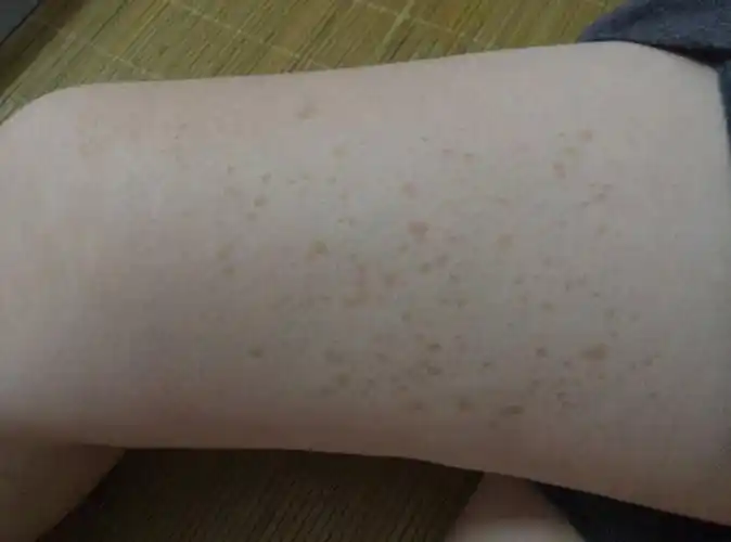 腿上长了褐色的斑,印象中是从中学时发现的,家人说好像在小学时期就有