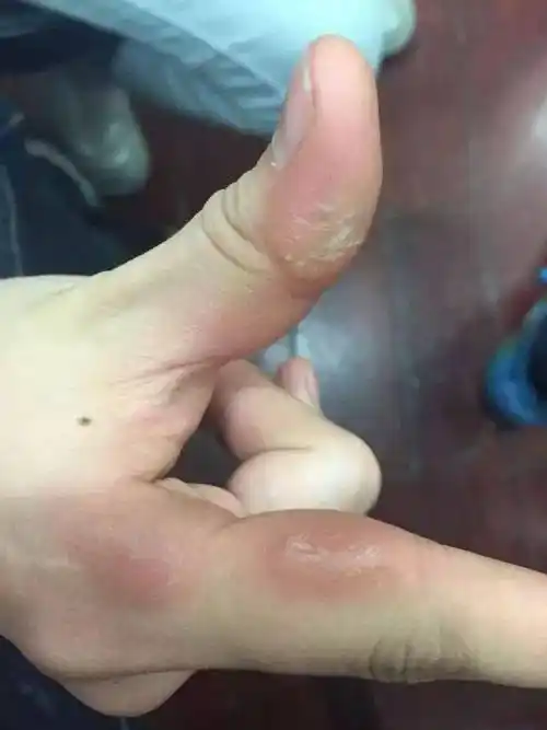 学乐器的人,手都长得一言难尽啊……_茧子