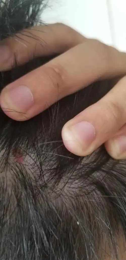 头皮上长了红色疙瘩,长了有2年多了,现在是不痛不痒,以前也应该不怎么