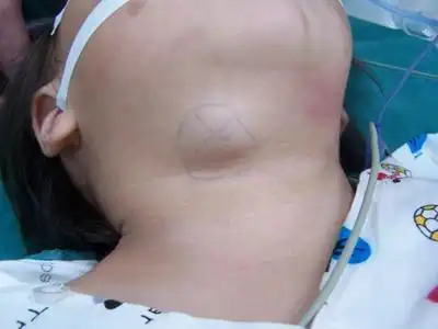 海绵状淋巴管瘤的症状和图片 - 有来医生