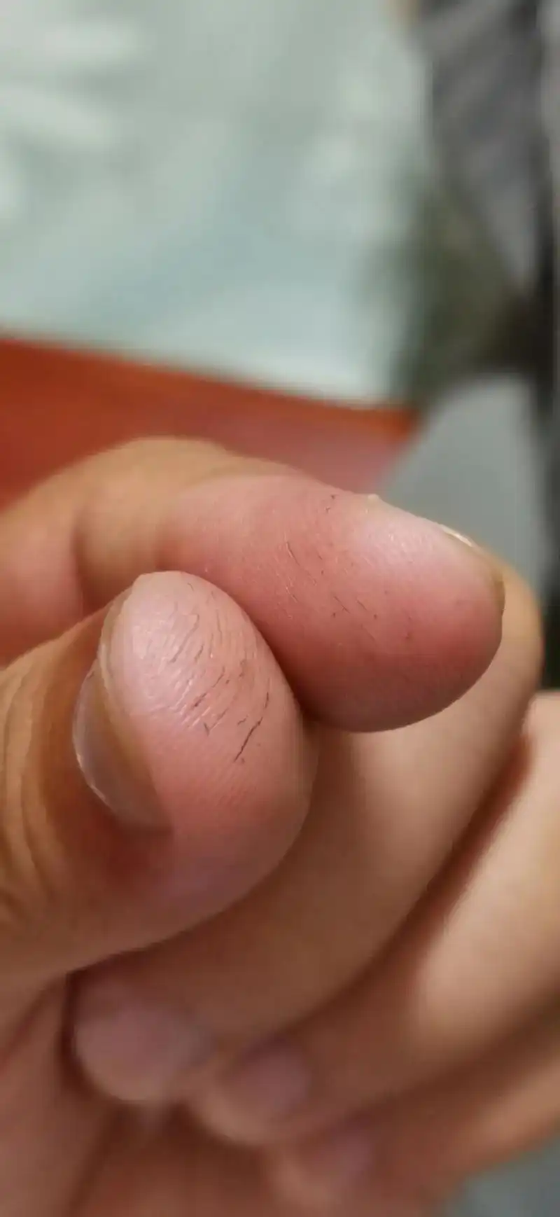 经常钓鱼掐蚯蚓手指的皮肤都开裂脱落了