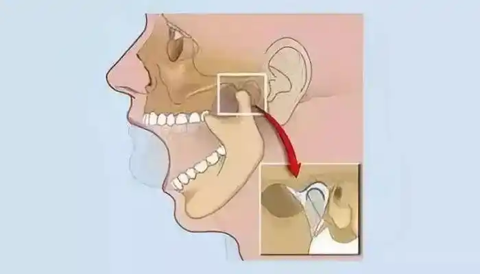颞颌关节炎如何治疗,常见的颞颌关节的护理