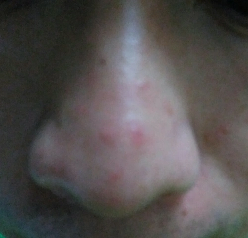 去游泳回来,鼻子上长了几颗红点,不痛也不痒,是什么呢?