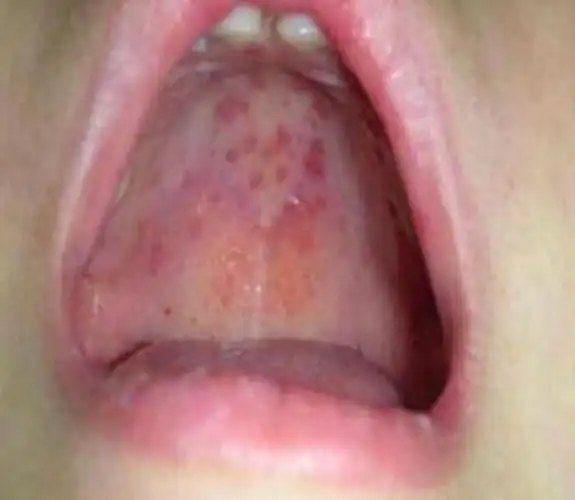 小朋友手足口病的图片