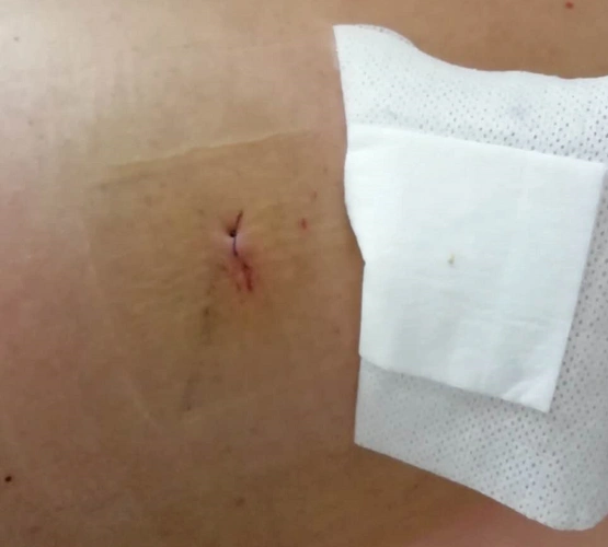 技术创新微创椎间孔镜手术让我第二天就下地了