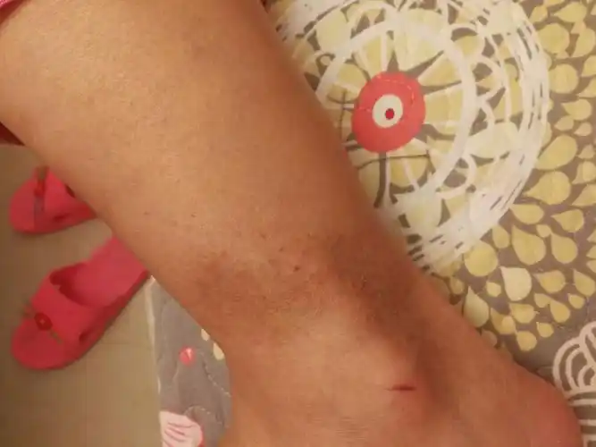 脚踝处出现斑和红色出血点,发黑怎么回事