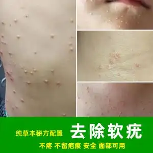 儿童软疣水猴子去除传染性软疣儿童成人扁平疣镊子刮勺瘊子的药膏
