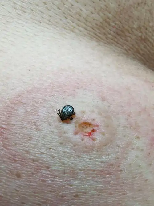 蜱虫叮咬后怎么办