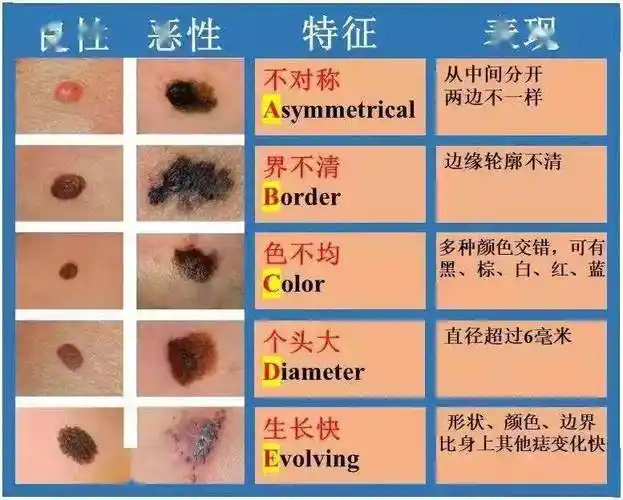 辽宁省细胞生物学学会骨肿瘤专会商冠宁教授做客健康来了|足"痣需多谋