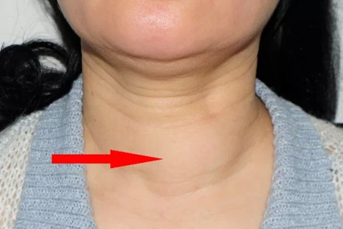 患了甲状腺癌会有什么症状呢?