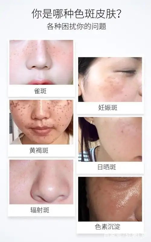 针对各种斑的修复方法,值得收藏!