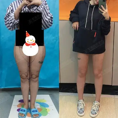 假胯宽##假胯宽吸脂##吸脂减肥