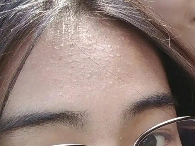 寻香师简单1招轻松解决闭口粉刺