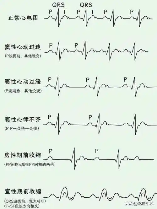 终于有人把心电图怎么看懂讲清楚了 676767