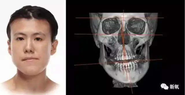 但是有时候医生技术不到位导致原本正常的下颌骨变得不对称,而造成脸