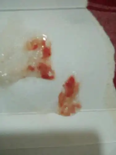 为什么每隔两天就咳有血色的脓痰出来呀?