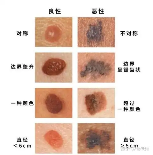 癌变了的痣其实是黑色素痣我们常说的「痣」(黑痣)黑色素痣(肉痣)错构