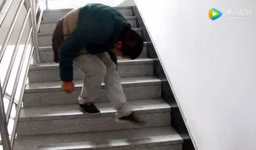 萧山男子严重驼背20年前胸贴大腿内脏挤成一团