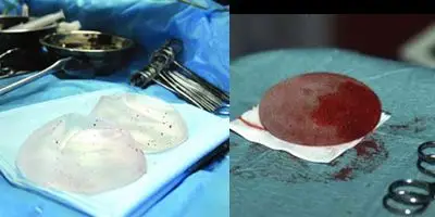 > 日本女子真实隆胸手术过程图(3)