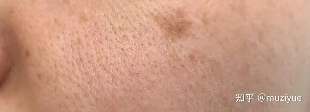 换季毛孔粗大怎么解决60