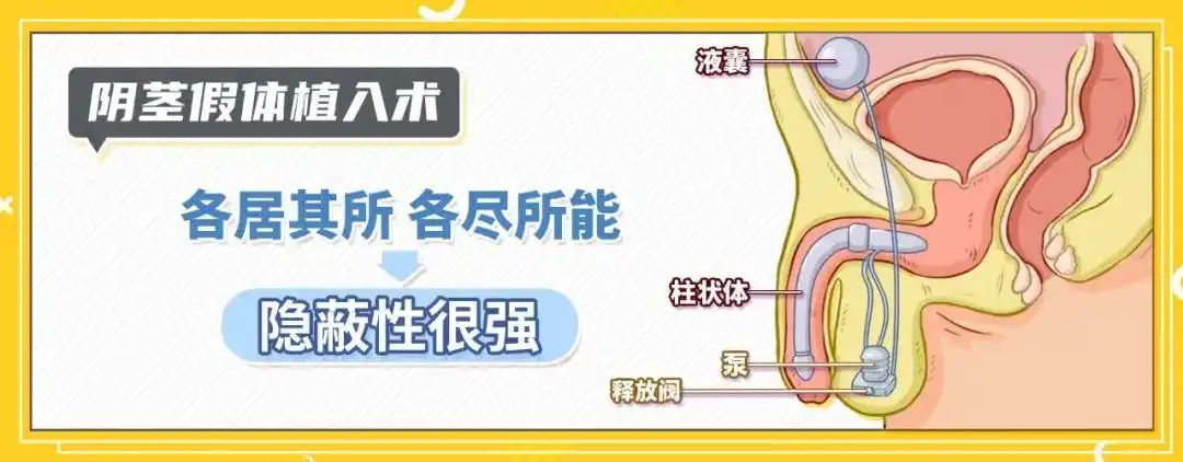 这种治疗阳痿的方法隐蔽安全时效长还保修