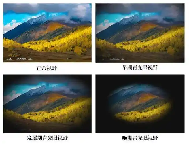 急性青光眼症状一般非常明显,表现为眼睛剧烈的疼痛,鼻根部的酸胀伴有