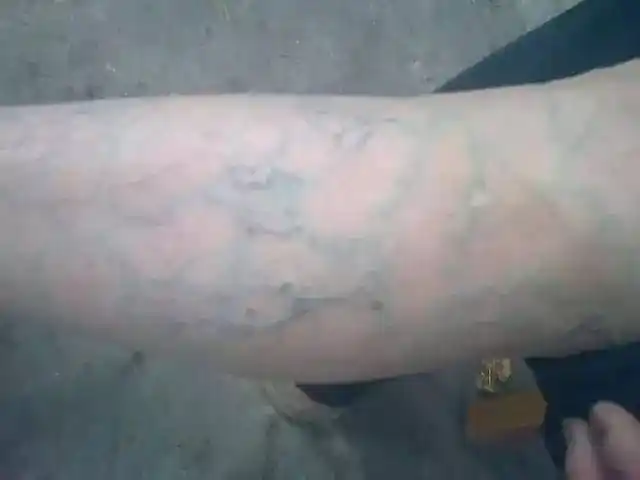 静脉曲张:满腿青筋夏天都不敢穿短裙热裤?