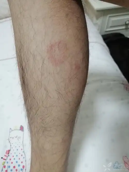 躯干,四肢近端典型环形红斑