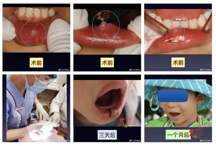 【粘液腺囊肿需要手术治疗吗?】 - 好大夫在线