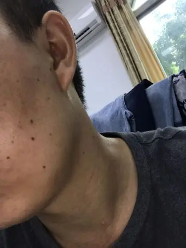 脸上好多这种黑色小点点,谁能知道是什么原因引起的吗?怎样去除?