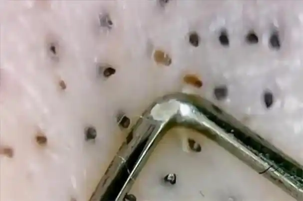 螨虫最怕这3种东西 螨虫用肉眼能看见吗-世界十大百科