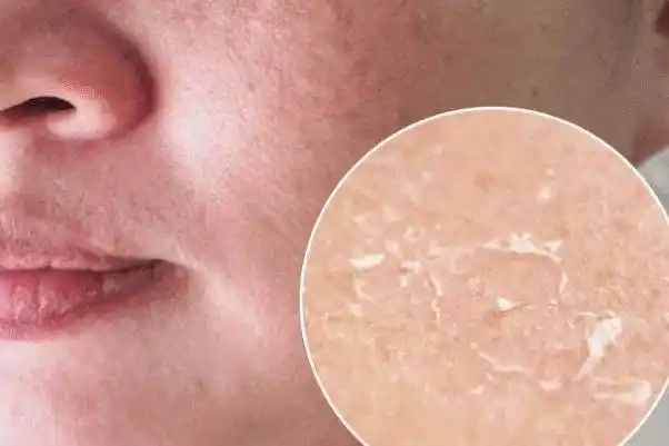 皮肤干燥脱皮严重像鱼鳞怎么办 皮肤干燥起皮像鱼鳞是怎么回事-5号网