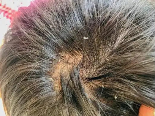 头痒头皮屑多,是身体发出的求救信号!如何解决?