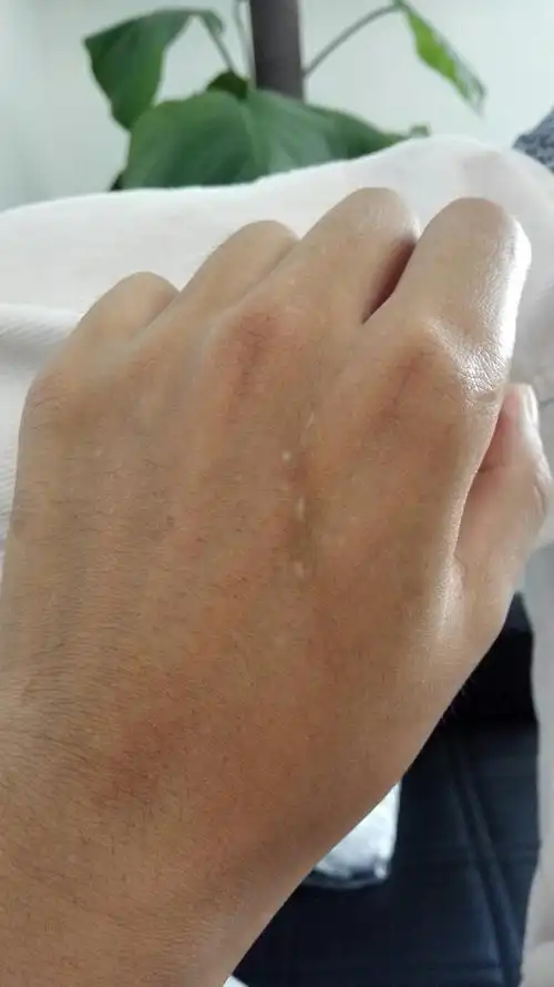 自从国庆去了泰国回来后,发现手背上有了这个