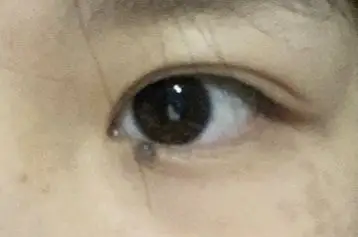 我眼角这颗痣能切掉吗