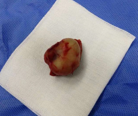 人体是怎么得豆腐渣瘤的?豆腐渣瘤需要如何重视?