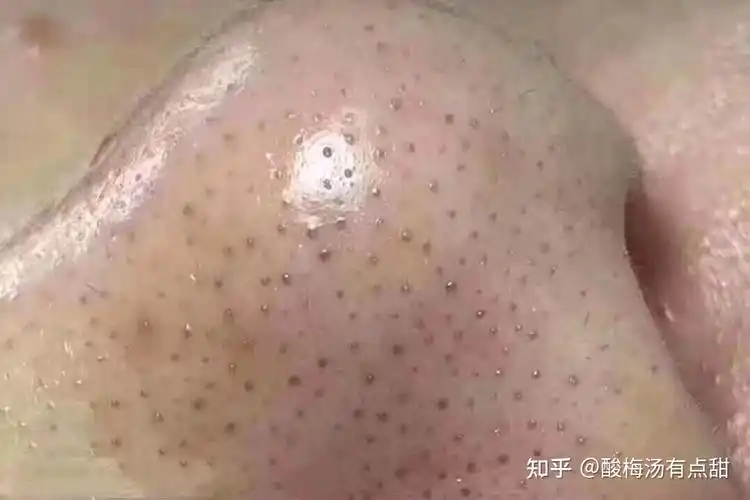 毛孔长摸起来刺刺的拔出来后一条白白硬硬的是什么东西呀