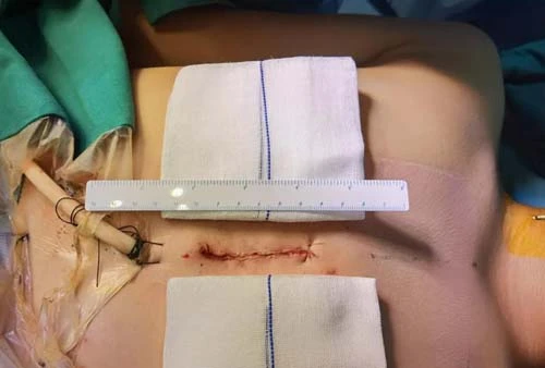 【疑难危重提升工程】钢针刺入心脏!