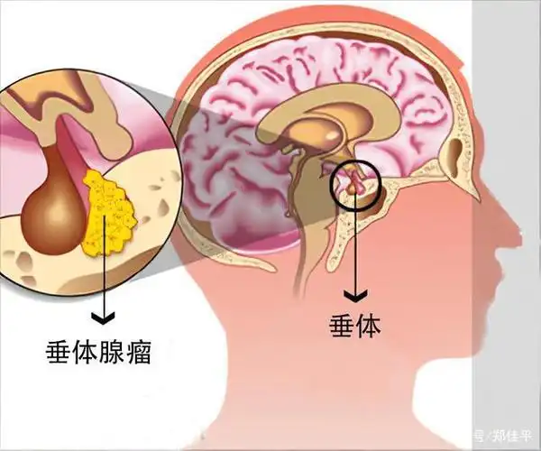 垂体泌乳素腺瘤的诊断与治疗
