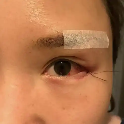 提眉 眼睑下至第二天