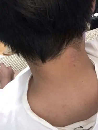 脖子后面长了一块东西