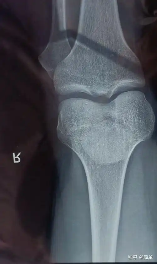 朋友们我这个骨骼线闭合了吗还能生长不