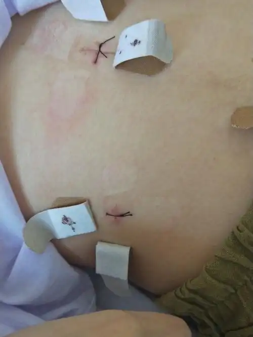 胆囊息肉切除胆囊术前术后