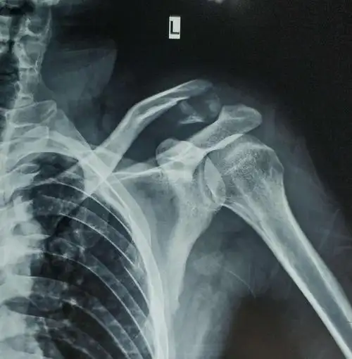术前左锁骨x线片