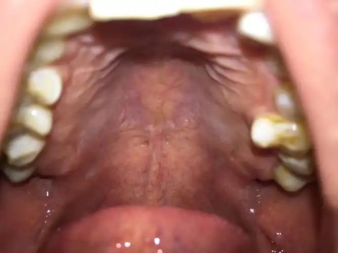 口腔上颚长中间火山坑一样的密密麻麻的是什么?