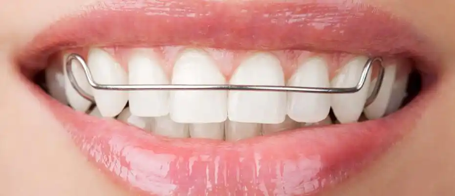 牙齿正畸后保持器佩戴的注意事项_牙套