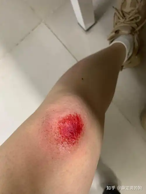 摔到了膝盖,小腿也有轻微擦伤